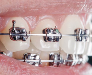 Ortodonti Nedir? (Diş teli tedavisi)