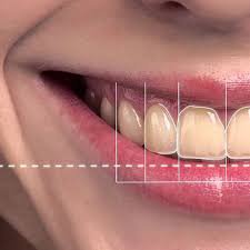 Estetik gülüş tasarımında neler yapılmaktadır? Estetik diş tedavileri